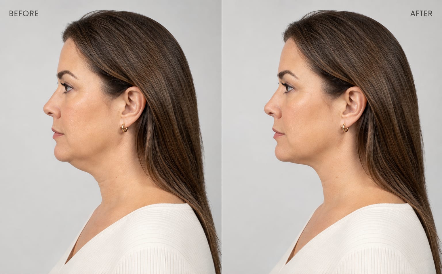 Side profile before and after jawline refinement