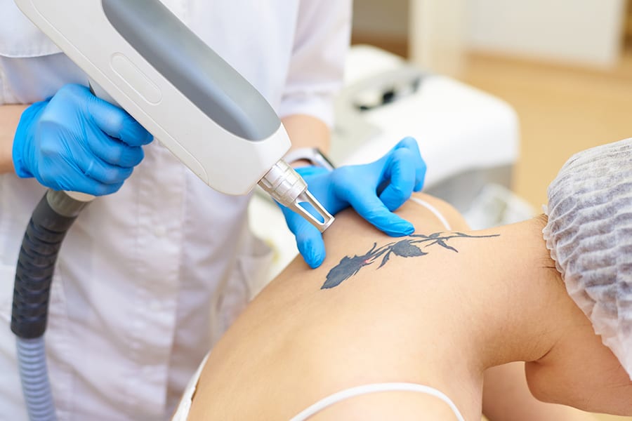 Laser Tattoo Removal